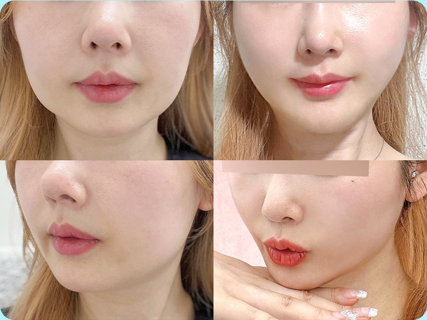 투명브이리프팅 시술 전과 1개월 후