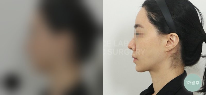 투명브이리프팅 A+B타입 — 시술 전(가림)·1개월 후