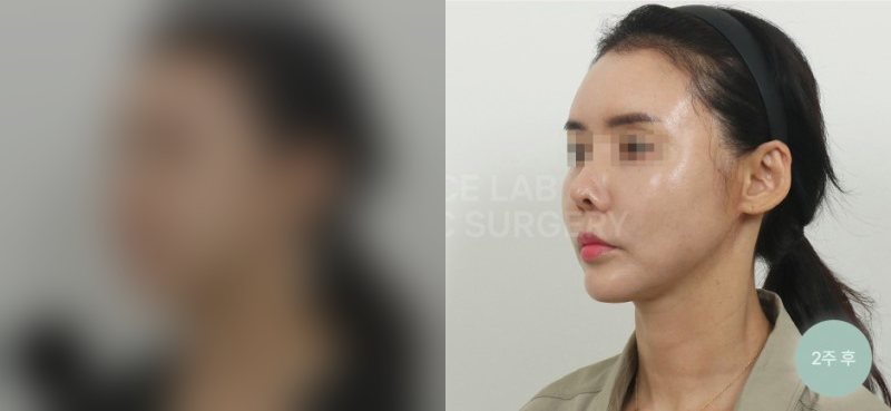 투명브이리프팅_A+B타입 [윤곽 후 처짐] — 시술 전(가림)·2주 후