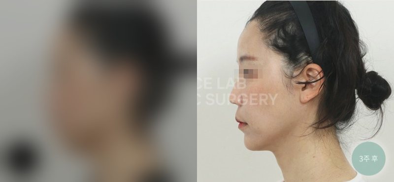 투명브이리프팅 B+N타입 — 시술 전(가림)·3주 후