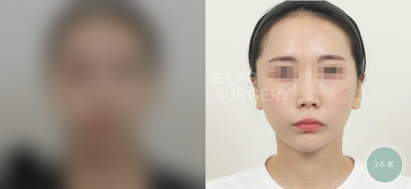투명브이리프팅 A+B타입 — 시술 전(가림)·2주 후