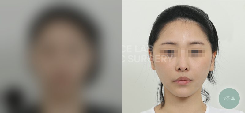 투명브이리프팅 B타입 — 시술 전(가림)·2주 후