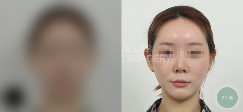 투명브이리프팅 A타입 — 시술 전(가림)·2주 후