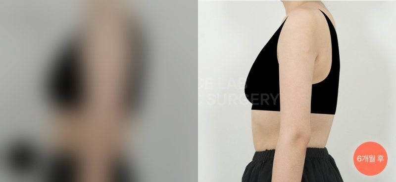 팔 아웃핏 — 시술 전(가림)·6개월 후