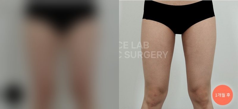 허틈 아웃핏 타이트 — 시술 전(가림)·1개월 후