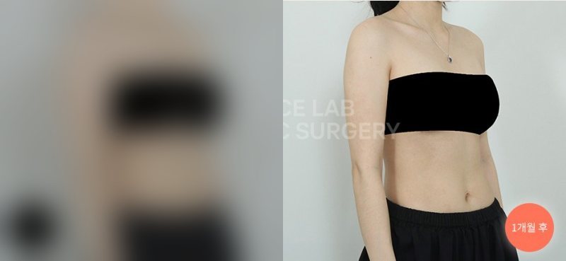 팔 아웃핏 타이트 — 시술 전(가림)·1개월 후