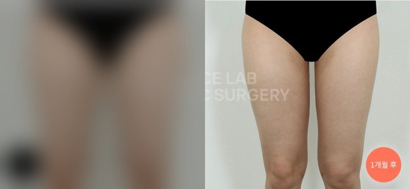 허벅지 아웃핏 타이트 — 시술 전(가림)·1개월 후