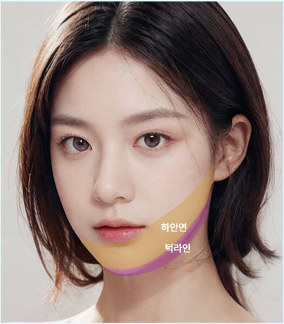 투명 V - B타입 하안면·턱라인