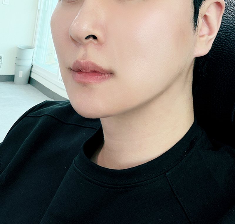 리프팅 후기 사진