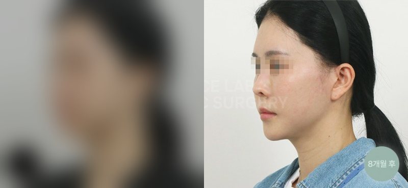이중고정 스마스 미니거상 — 시술 전(가림)·8개월 후