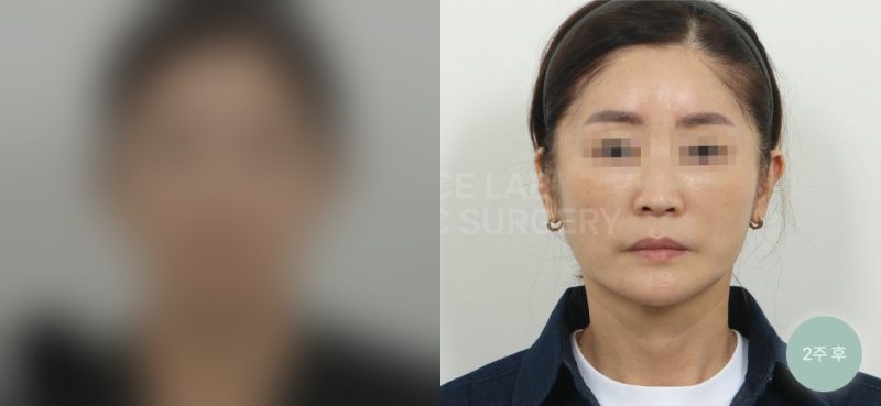 투명브이리프팅 A+N타입 — 시술 전(가림)·2주 후
