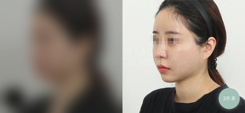 투명브이리프팅 B타입 — 시술 전(가림)·2주 후