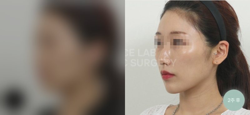 투명브이리프팅 A+B타입 — 시술 전(가림)·2주 후