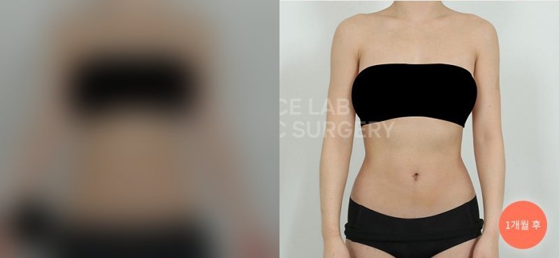 하복부 + 러브핸들 아웃핏 타이트 — 시술 전(가림)·1개월 후