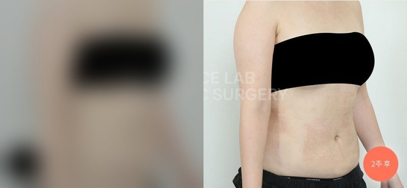 복부360 아웃핏 타이트 — 시술 전(가림)·2주 후