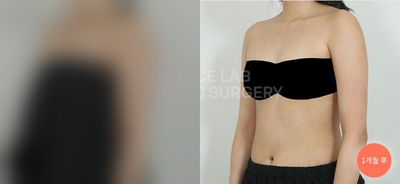 팔 아웃핏 타이트 — 시술 전(가림)·1개월 후