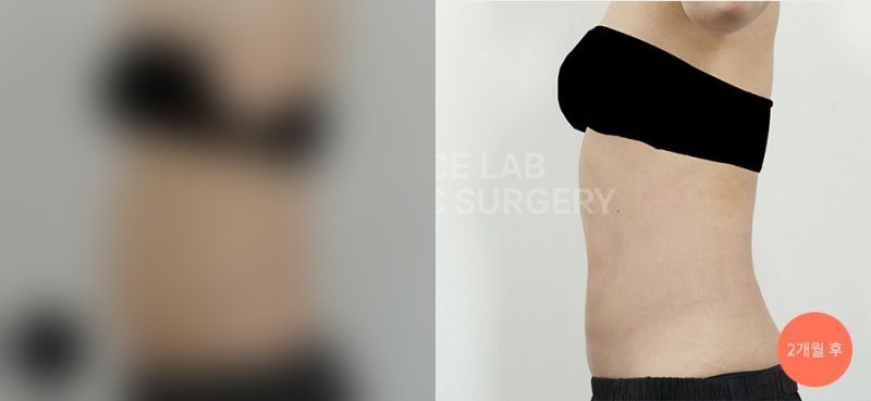 복부 아웃핏 타이트 — 시술 전(가림)·2개월 후
