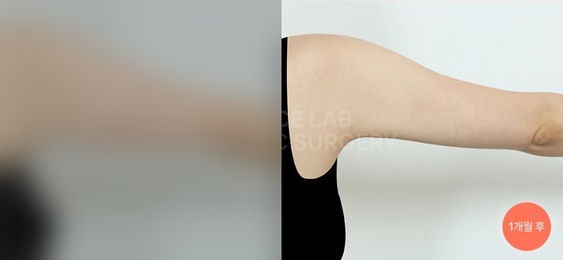 팔 아웃핏 — 시술 전(가림)·1개월 후